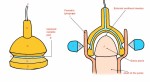 Picture for patent available